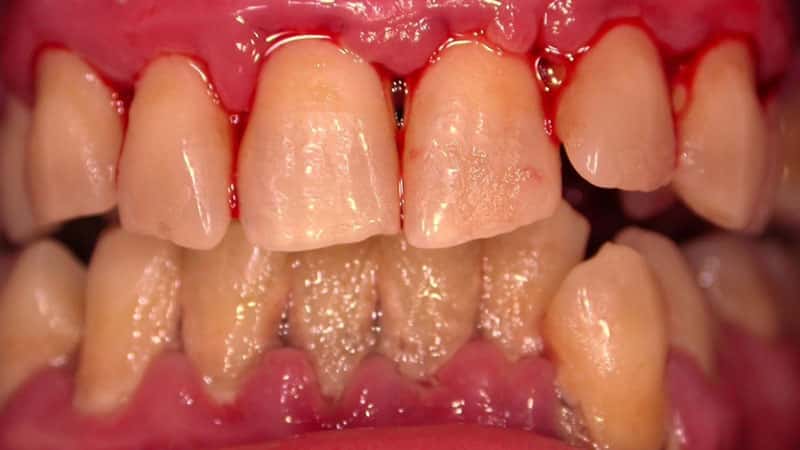 Болезнь десен лечение народными средствами