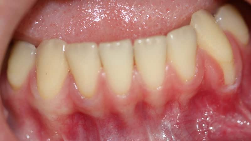 Симптомы опущения десен