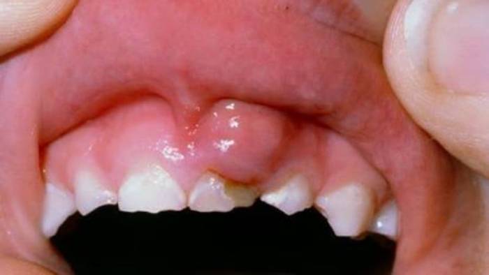 нарыв на десне лечение в домашних условиях