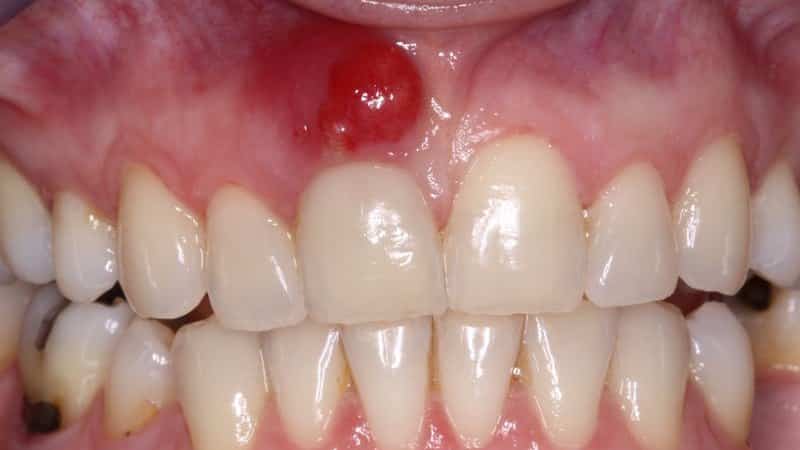 как лечить нарыв на десне что делать