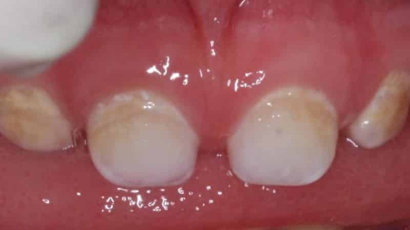 некариозные поражения зубов возникающие до прорезывания зубов