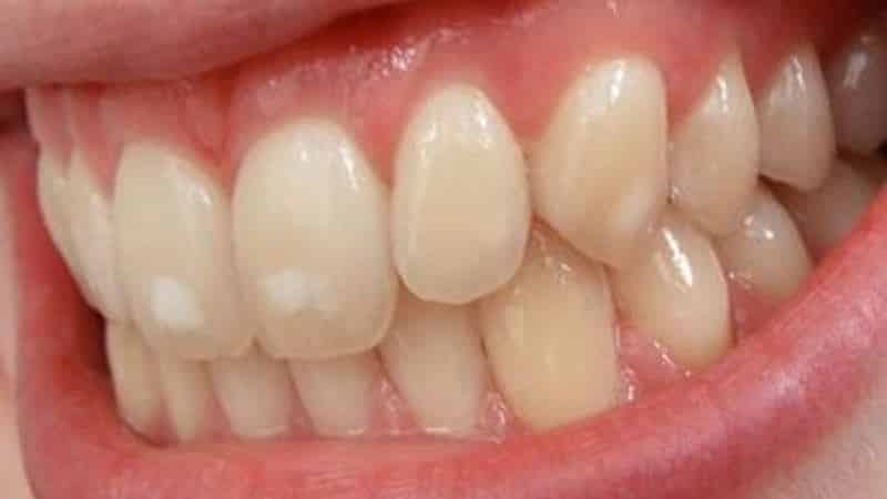 классификация некариозных поражений зубов