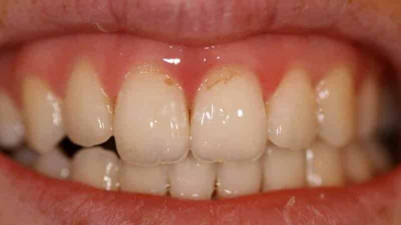 некариозные поражения зуба