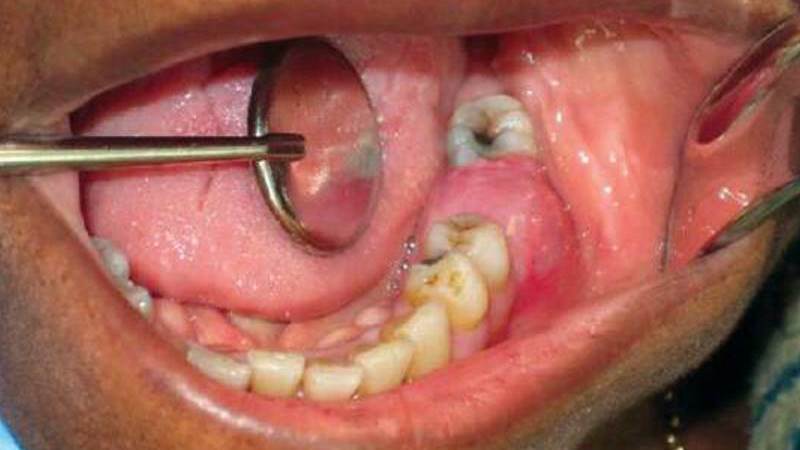 после удаления зуба мудрости запах