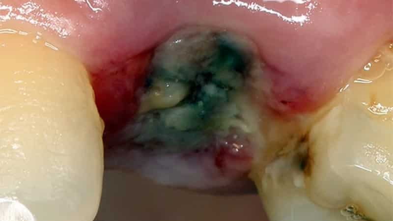 неприятный запах от зуба мудрости