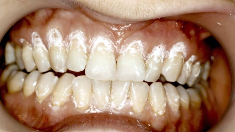 чувствительная эмаль зубов что делать