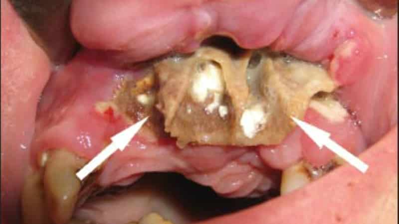 хронический остеомиелит нижней челюсти