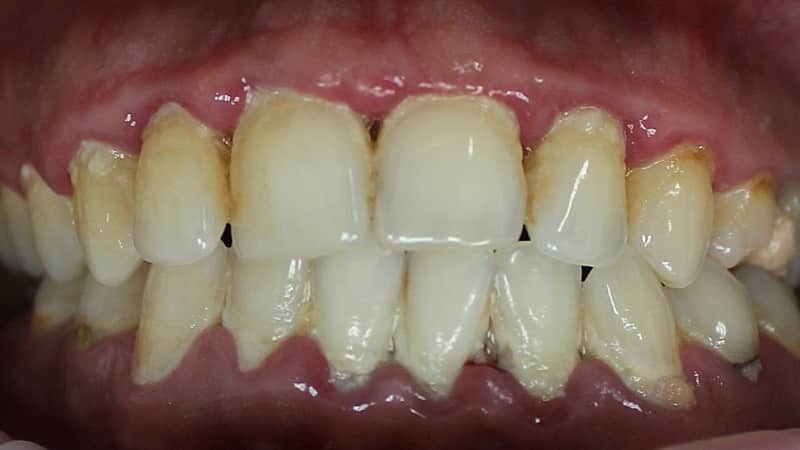 оголяются корни зубов что делать причины