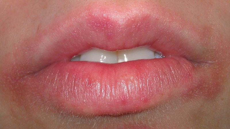 ожог губы что делать