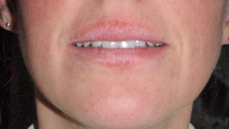 ожог губы фото