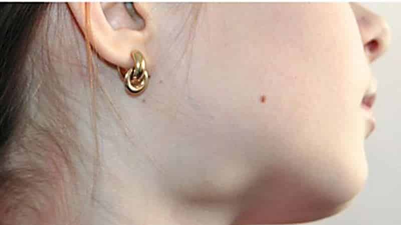 болезни слюнных желез