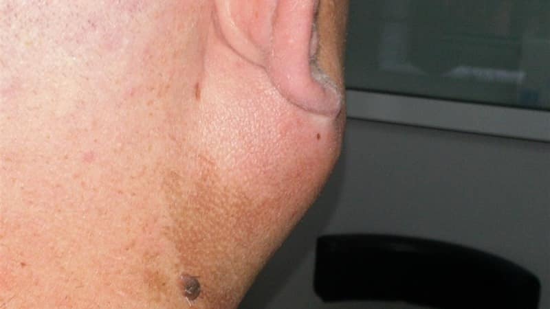 заболевания слюнных желез симптомы