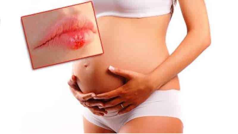 чем лечить герпес на губе при беременности 2 триместр