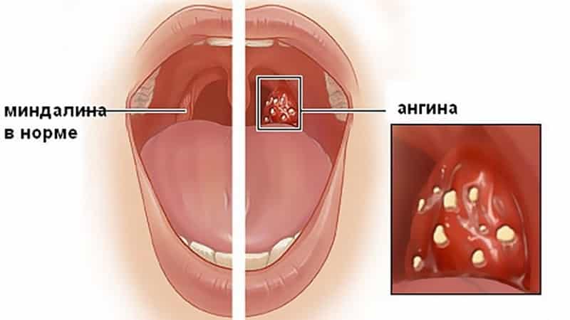 опухли гланды что делать