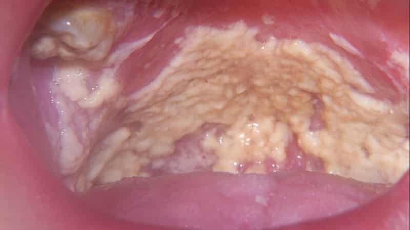 опухло небо и болит