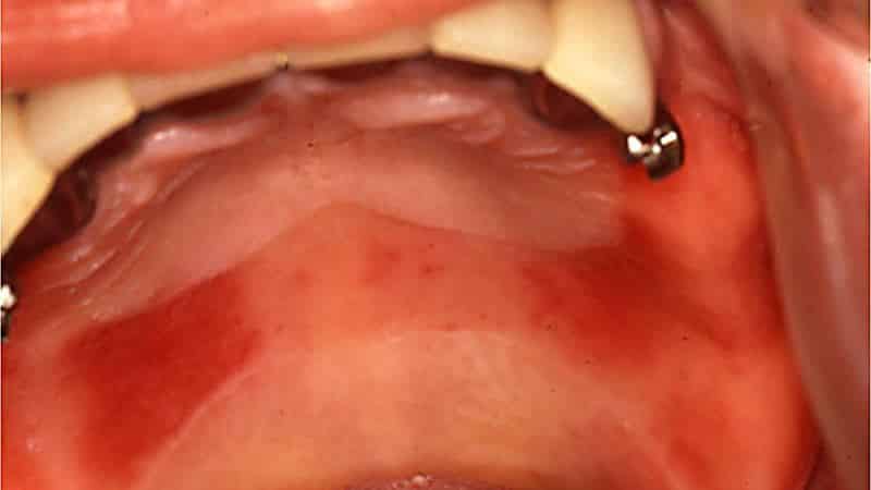 что делать если опухло небо