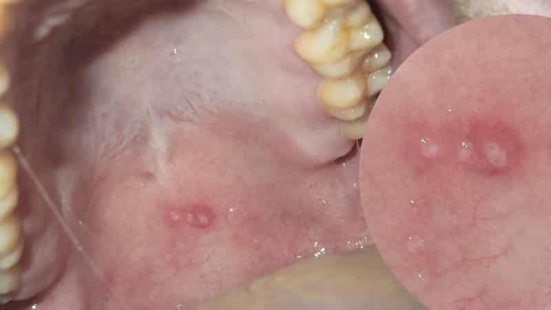 отек неба причины