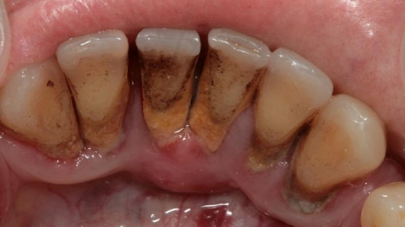 десна поднялась над зубом что делать