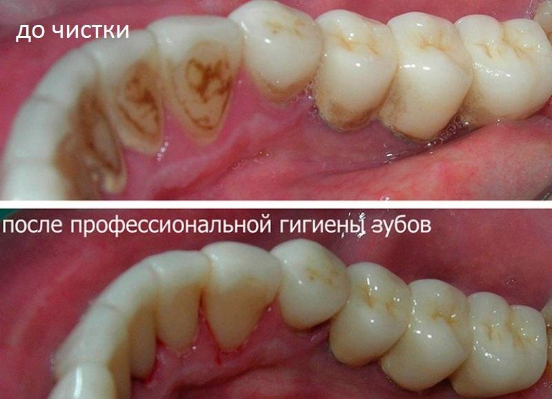 опустилась десна на зубе