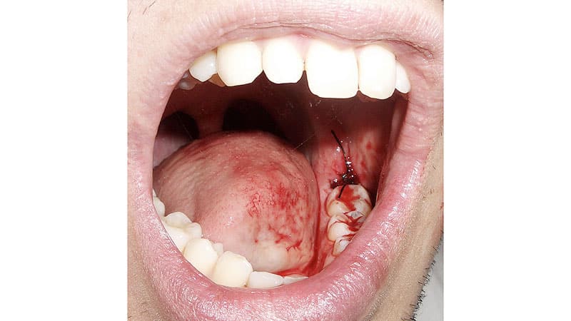 Последствия удаления зуба мудрости