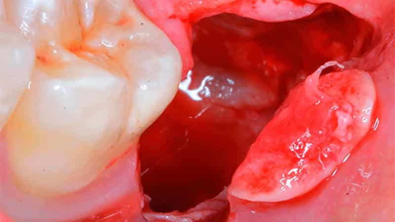 Даление зуба мудрости