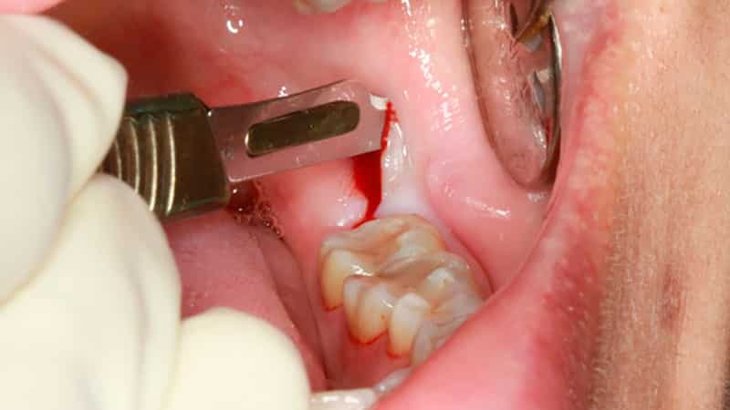 Удаление зуба мудрости