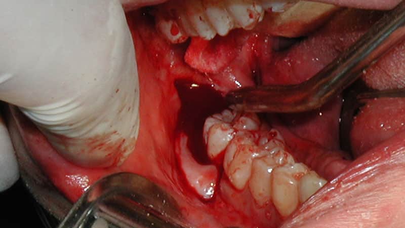 Удаление нижнего зуба-восьмерки