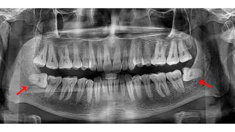 Особенности удаления восьмерки