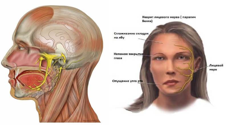как лечить лицевой нерв в домашних условиях