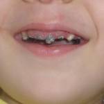 Кариес у ребенка Кариес у ребенка