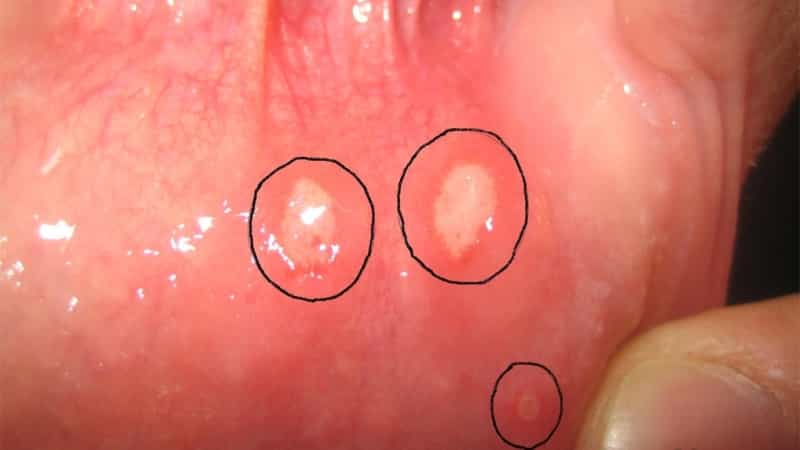 от чего появляется стоматит во рту