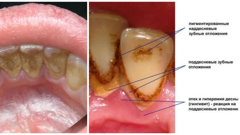 от чего появляются камни на зубах причины