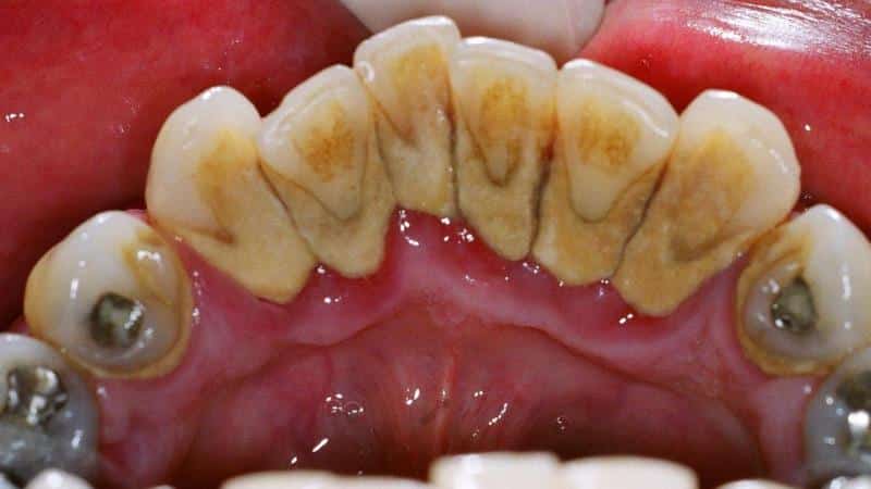 почему образуются камни на зубах