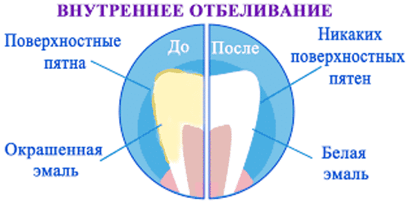 полоски для отбеливания зубов crest whitestrips отзывы