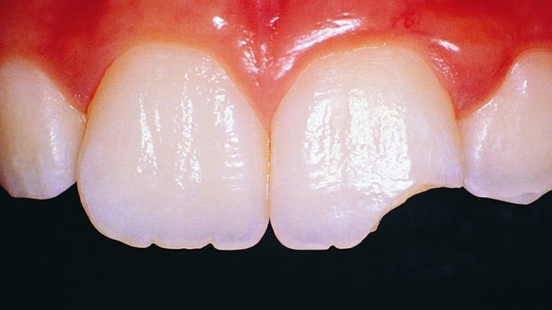 откололась эмаль зуба что делать