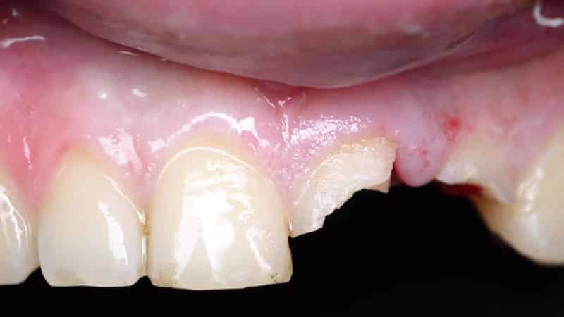 скол зуба что делать