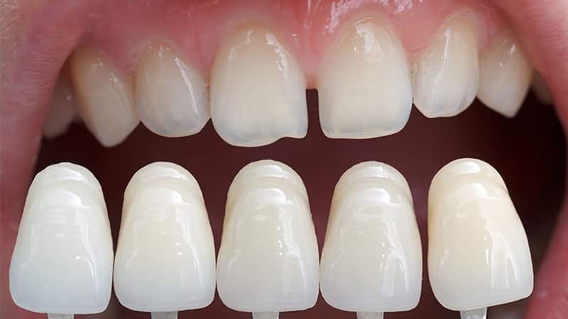 скол зуба лечение