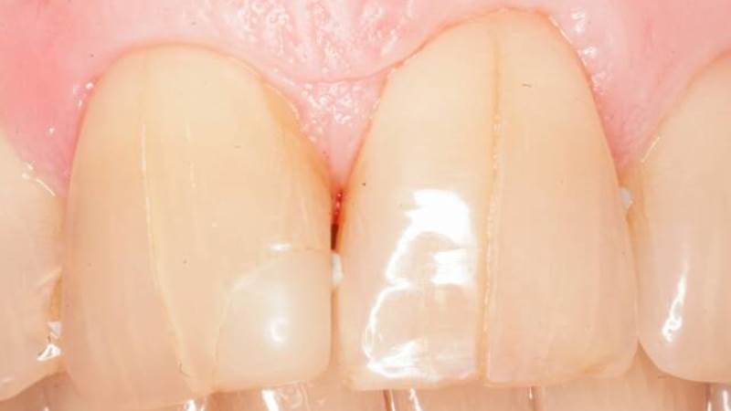 скол зуба способы лечения