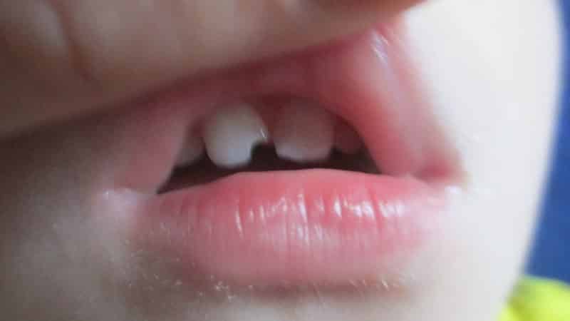 скол зуба как лечить