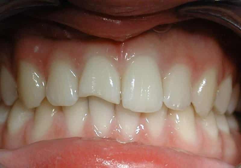 откололся зуб что делать