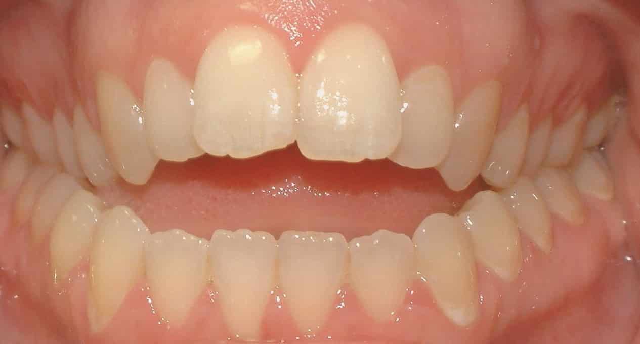 открытый прикус