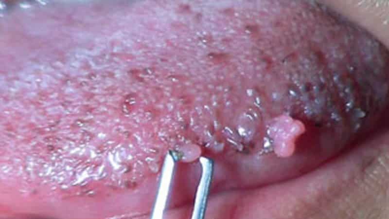 папиллома на языке фото