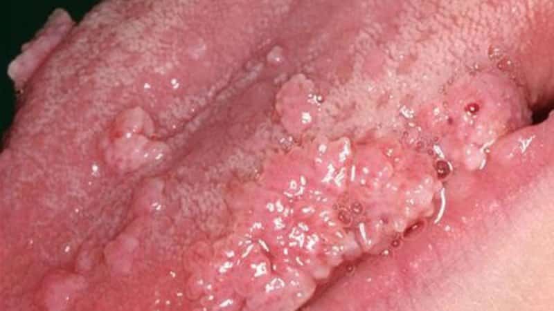 удаление папилломы на языке отзывы