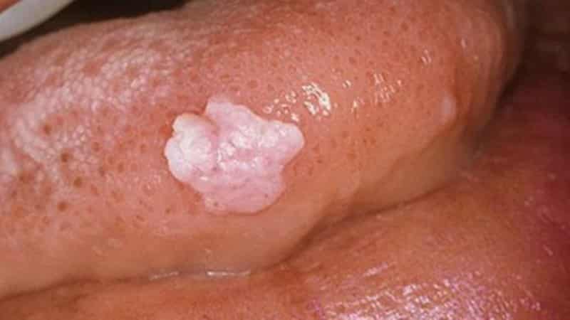 папилломы под языком фото