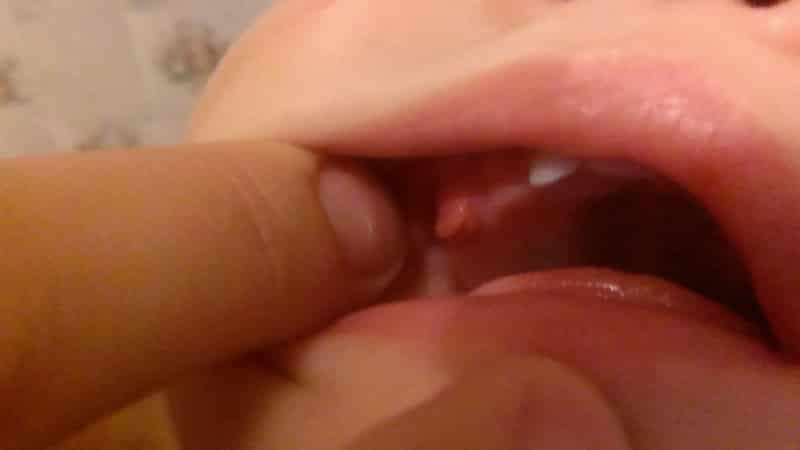 папиллома на небе