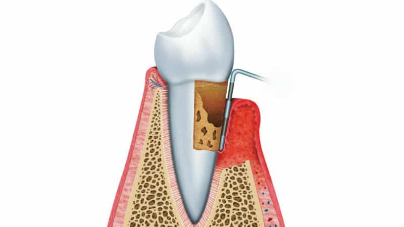 кюретаж пародонтального кармана