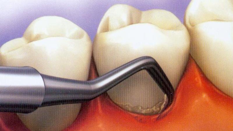 пародонтальные карманы фото