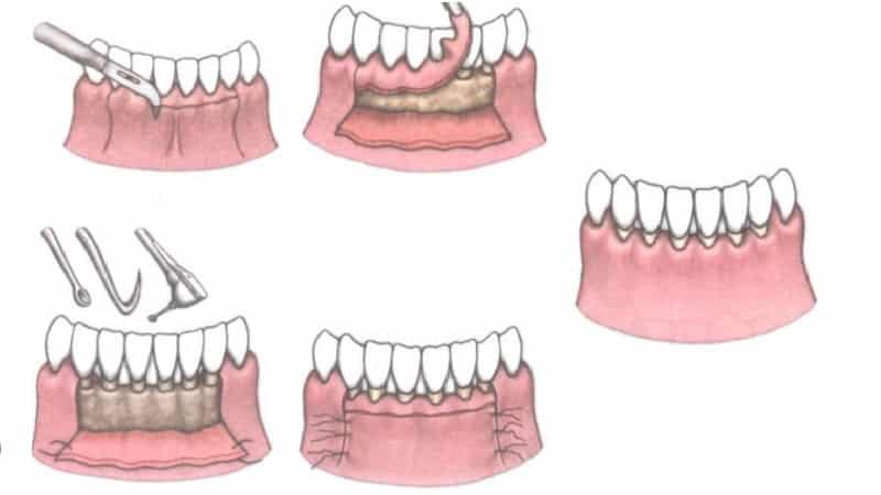 открытый кюретаж пародонтальных карманов
