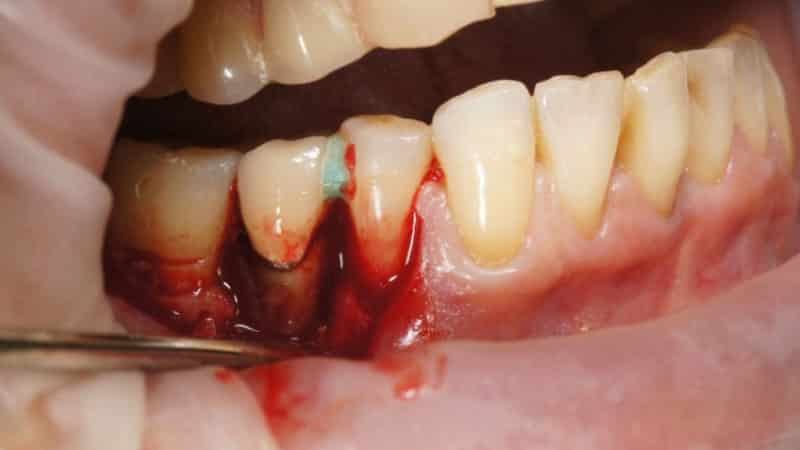 кюретаж зубов