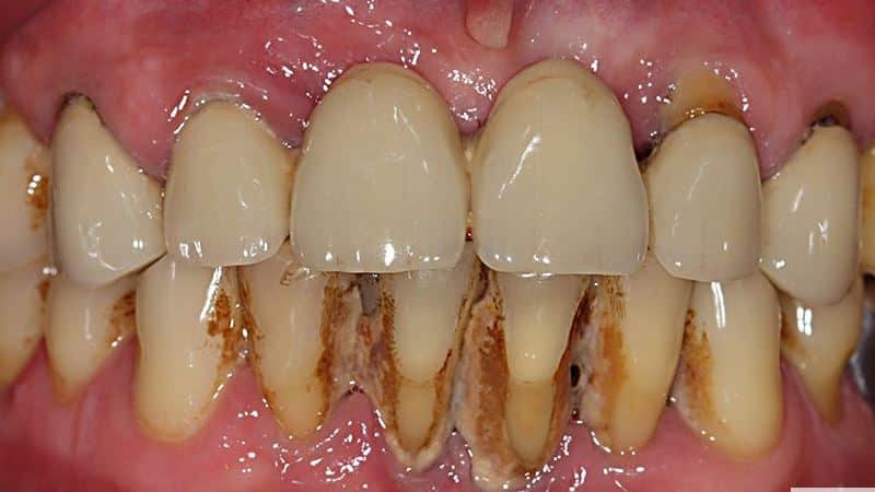 пародонтит лечение в домашних условиях